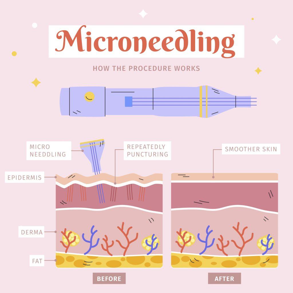 microneedling procedure
