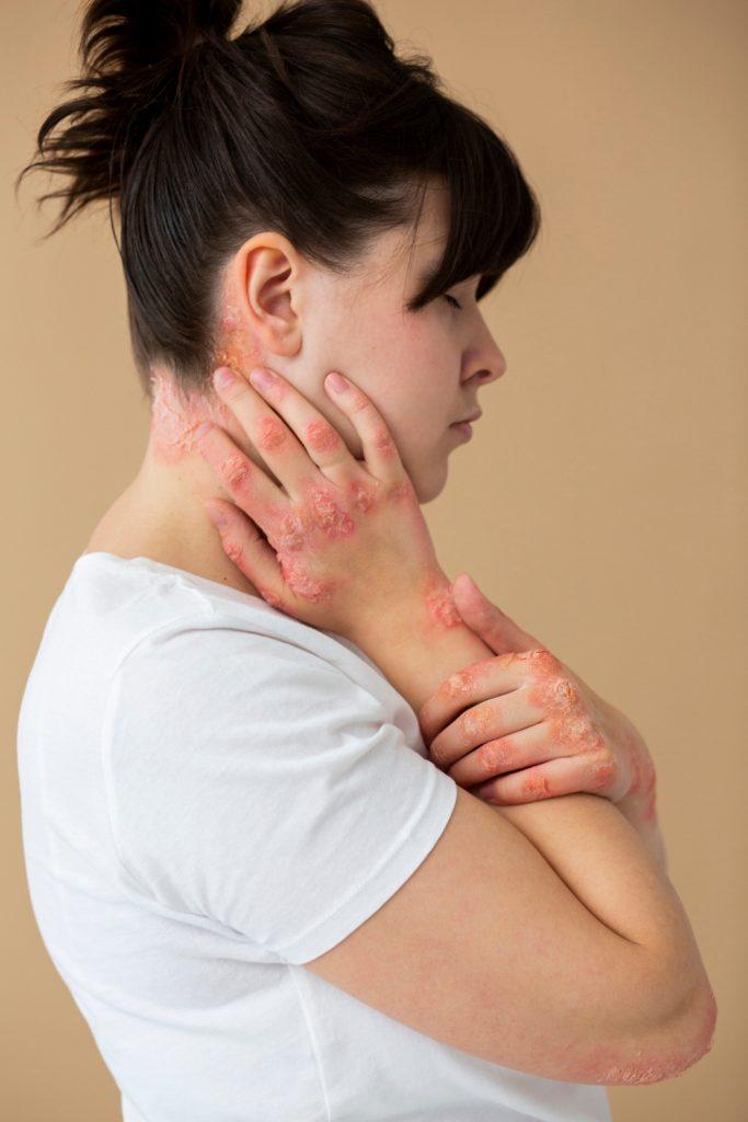 Psoriasis Explained