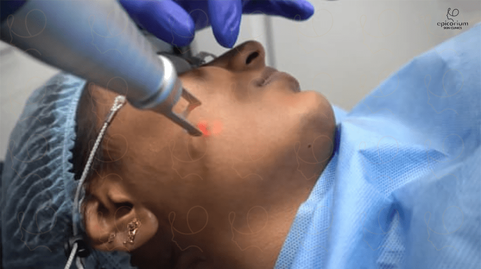 best carbon laser peel in bangalore