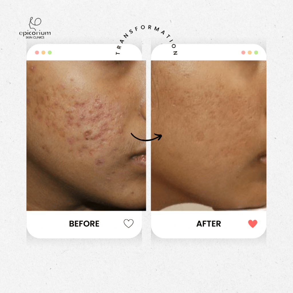 Open Pores Treatment in Bangalore – Before and After Results